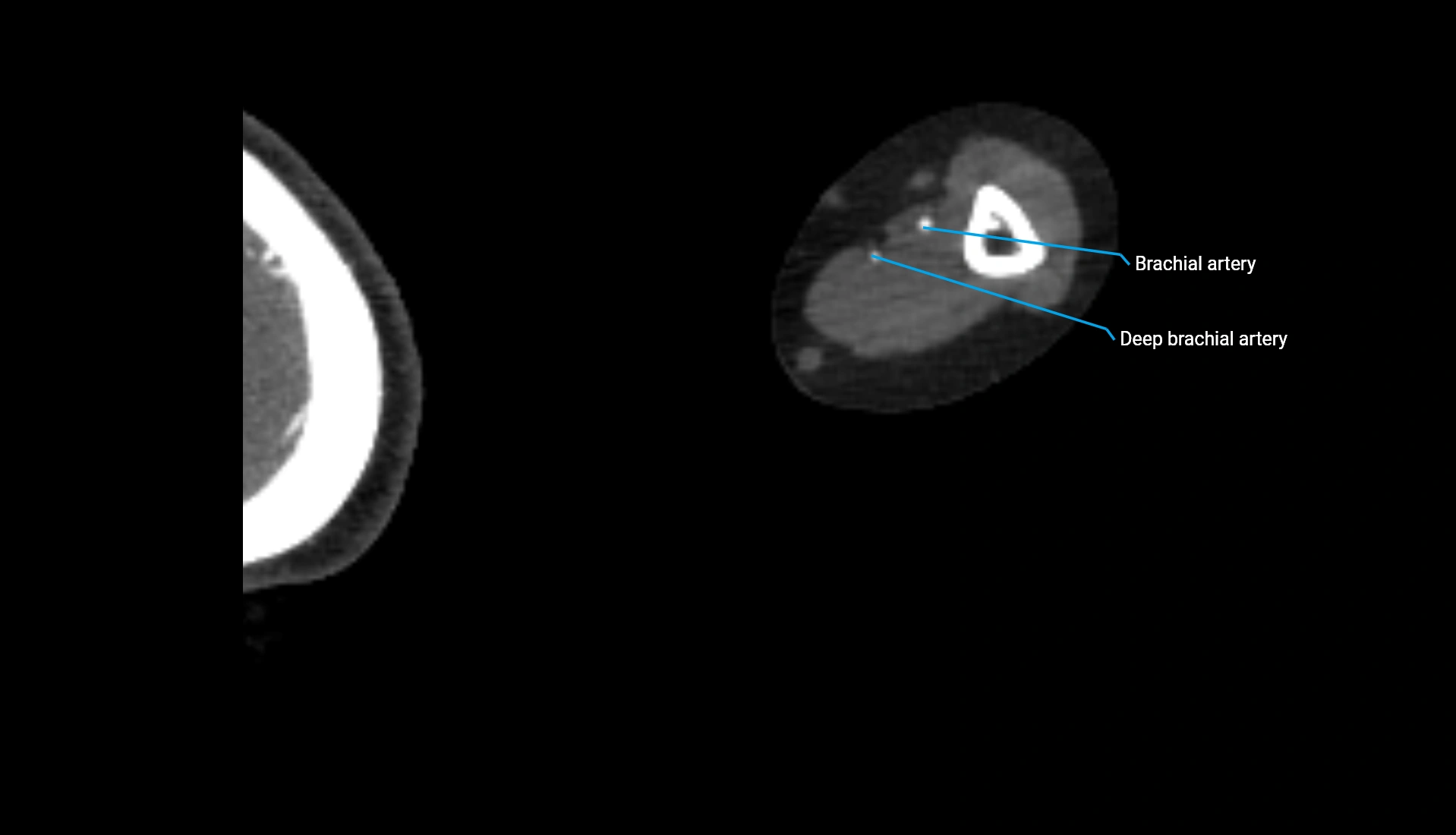 CTA upper limb axial cross sectional anatomy labelled image 214 (2).webp